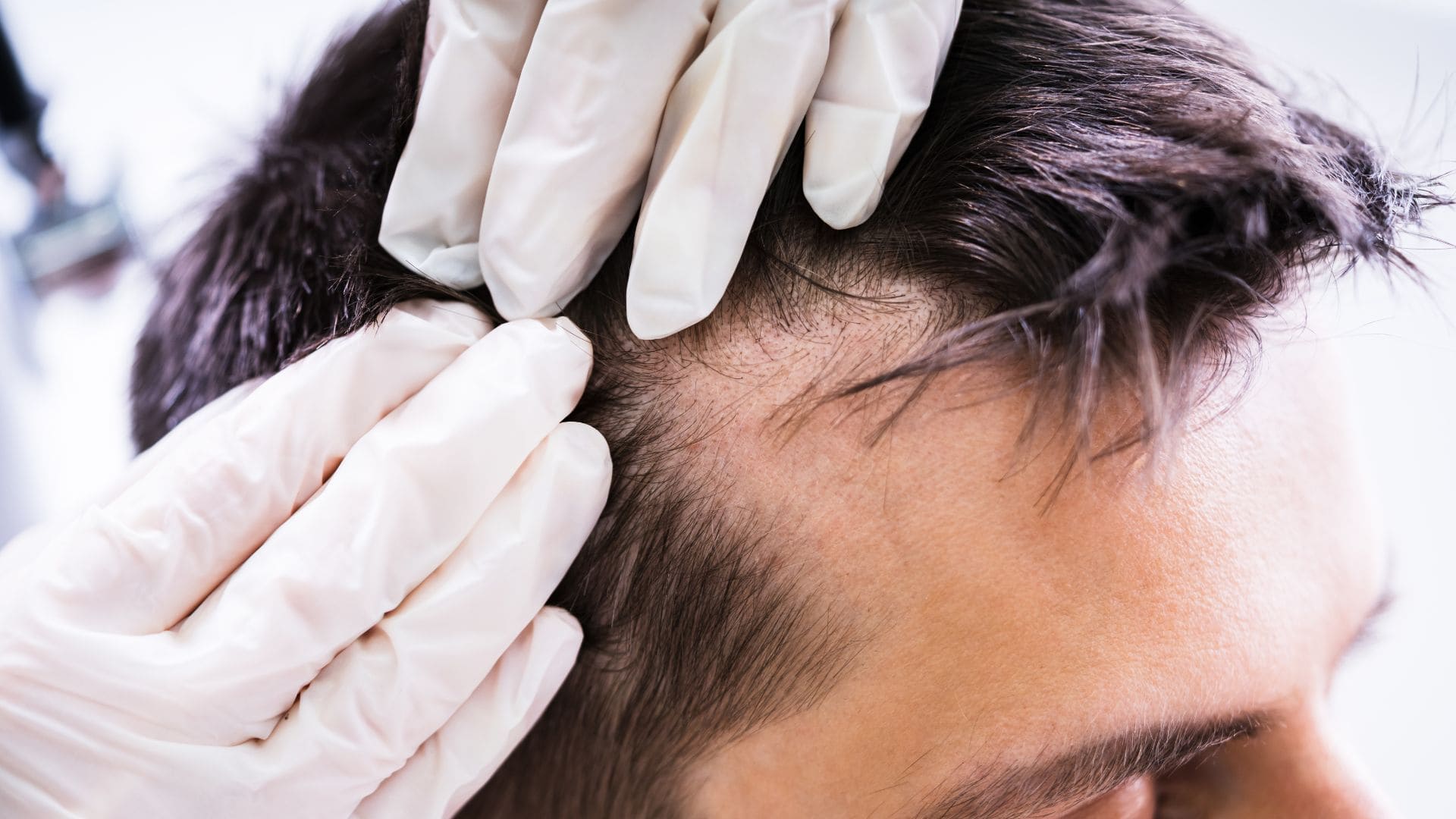 Regeneración capilar hombre - Beauty infinity